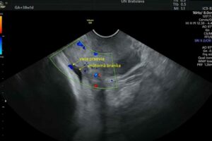 Obrázok 2. Vasa praevia v ultrazvukovom obraze pri zobrazení pomocou farebného doppleru